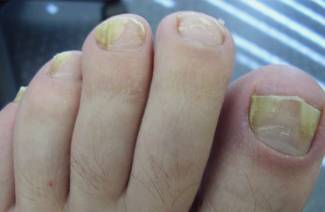 Comprimés pour mycose des ongles