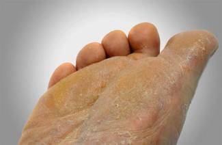 Mycose des pieds