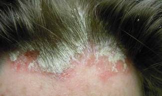 Régime alimentaire pour le psoriasis du cuir chevelu