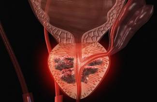 Sintomi del cancro alla prostata negli uomini