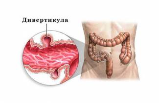 Diverticulose sigmoïde