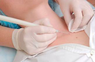 HPV nelle donne