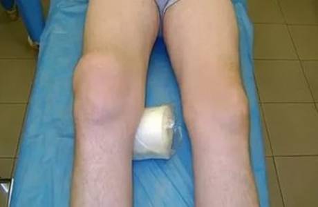 Diz osteoartrozunu deforme etmek