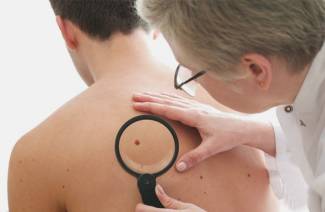 Come rimuovere il papilloma a casa