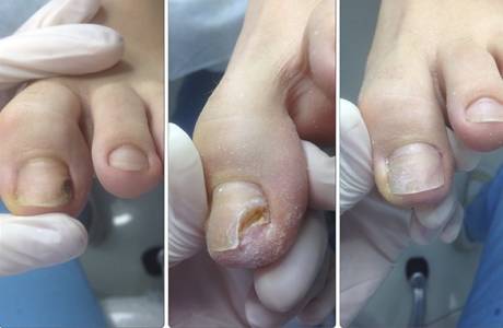 Ongles prothétiques