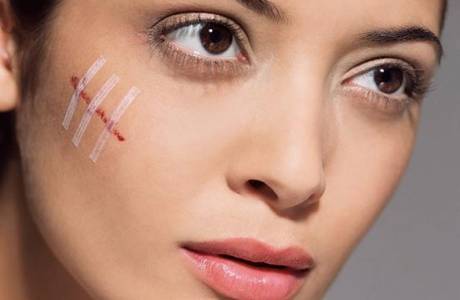 Facial scars