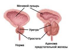 Prosztatadenoma kezelés
