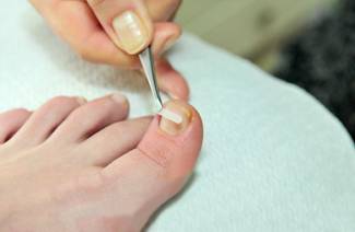 Correction des ongles incarnés
