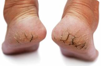 Comment traiter les fissures au talon