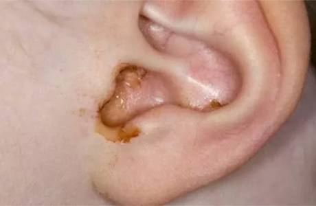 Pus la ureche