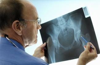 Fracture de la hanche