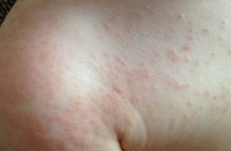 Herpes type 6