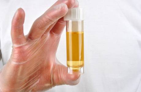 Glucose tiết niệu