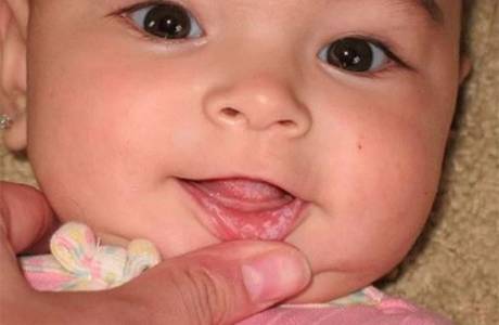 Plaque blanche sur les lèvres d'un enfant
