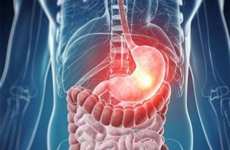 Candidiasis του στομάχου