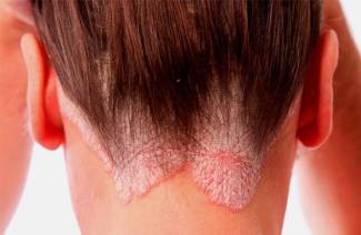 Psoriasis sur la tête