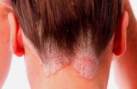 Psoriasis en la cabeza.