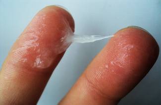 Candidose vulvite
