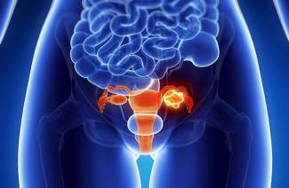 Indications pour l'ablation des fibromes utérins