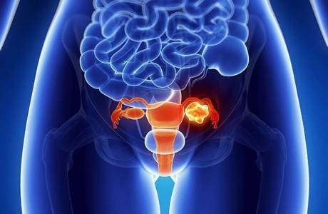 Indicații pentru îndepărtarea fibroamelor uterine