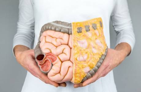Bệnh Crohn