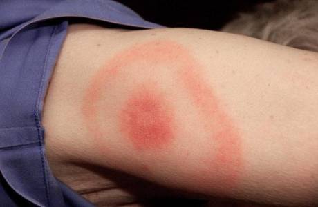 Borrelioosin oireet