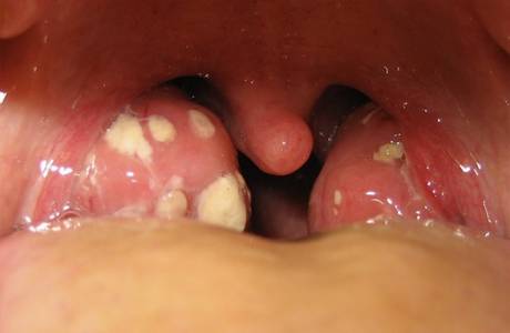 Medicina per il mal di gola