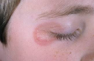 Champignon sur le visage