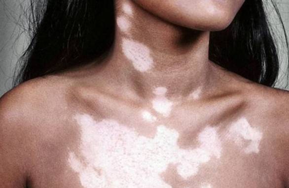 Taches blanches sur la peau après le bronzage