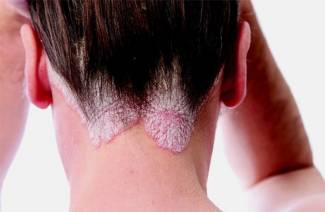 Pegano Diet pour le psoriasis