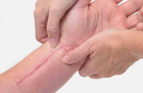 แผลเป็น Keloid