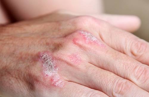 Pommades pour le psoriasis