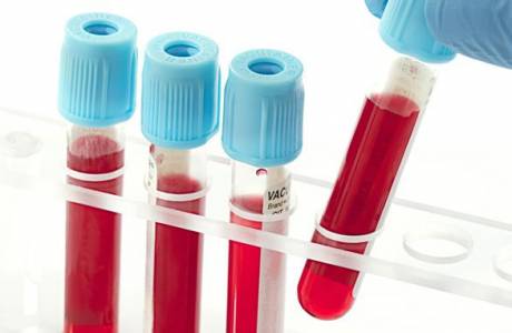 Ursachen für erhöhte Kreatininwerte im Blut