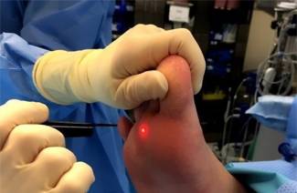 Élimination des verrues plantaires au laser