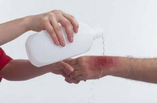 Que faire avec une brûlure d'eau bouillante