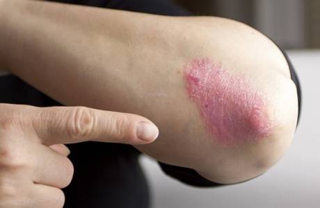 Psoriasis an den Ellbogen