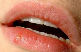 Herpes de laboratório