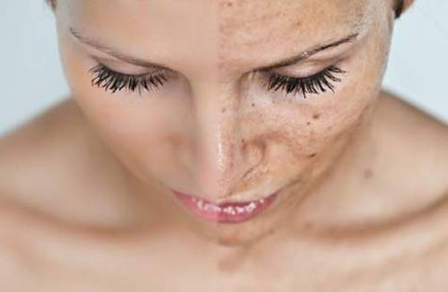 Crema para manchas de edad