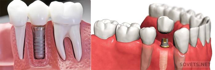 Diş implantasyonu