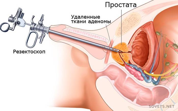 Prostat adenomunun tedavisinde minimal invaziv yöntemler