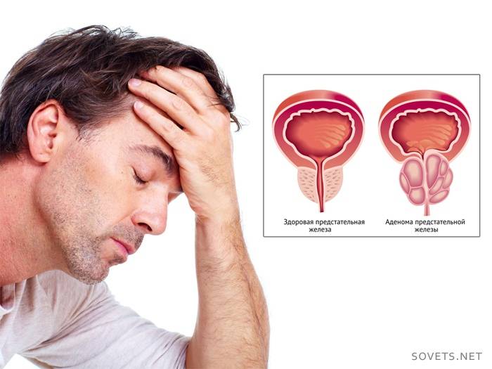 Prostat Adenoma Tedavisi