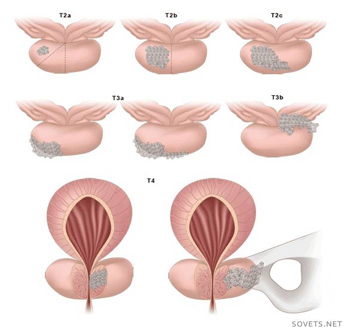 ยาสำหรับต่อมลูกหมาก adenoma