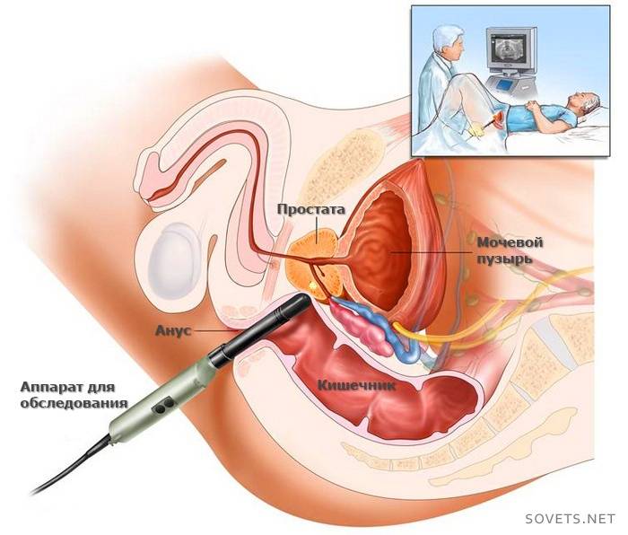 การผ่าตัดรักษาต่อมลูกหมาก adenoma