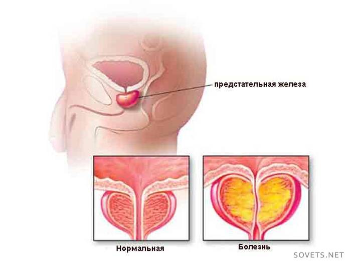 การรักษาต่อมลูกหมาก adenoma