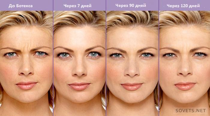 rimuovere le rughe con Botox