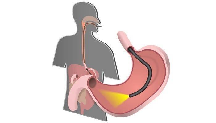 Endoskopija gastroduodenīta diagnozei