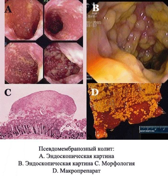 Pseudomembranöse Kolitis - die Bildung von fibrotischen Ablagerungen