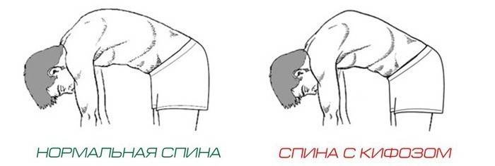 Нормална леђа и са знаковима кифозе