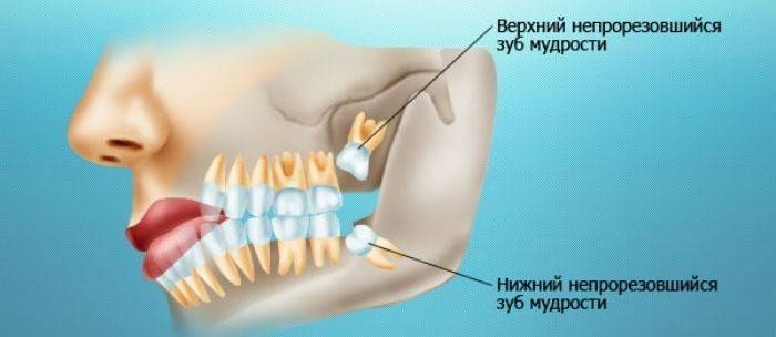 Răng khôn mọc như thế nào?