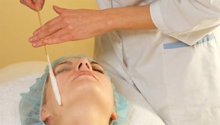Congelamento delle cellule basali con azoto liquido